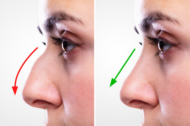 Rhinoplasty in New York - All You Need To Know!