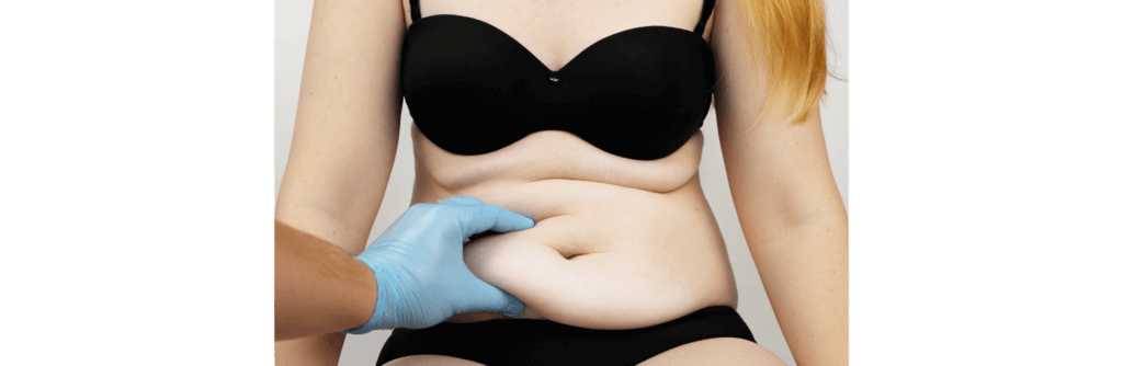 Tummy tuck