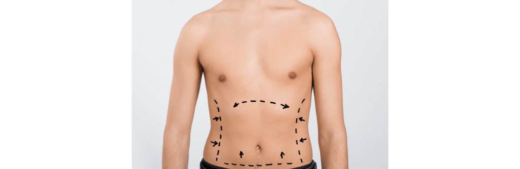 Gynecomastia- All that you need to know