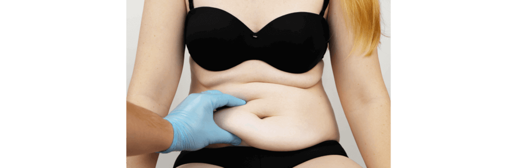 Should I choose a mini or a full tummy tuck?