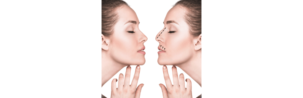 Reasons to consider revision rhinoplasty nyc